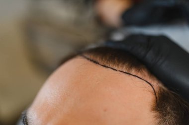 Hastanın kafa derisinde saç nakli prosedürü için saç çizgisi var. Bir trikoloğun eldivenli eli kafaya dokunuyor.