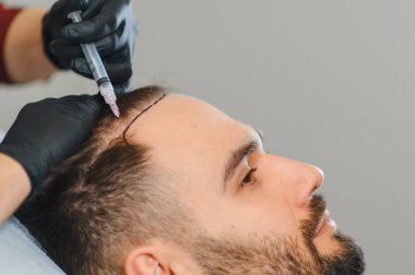 Kafatasını şırıngayla delen hasta, saç büyümesini teşvik ediyor ve trikoloğun kliniğinde alopeciyi tedavi ediyor.