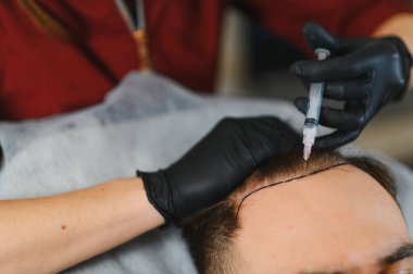 Trikoloji kliniğinde kafa derisi enjeksiyonu geçiren hasta, erkek şablonundaki kelliği ele alıyor ve saç uzamasını destekliyor.