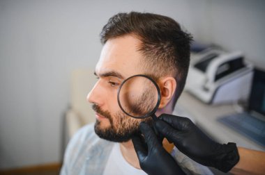 Siyah eldivenli trikoloğum büyüteçle bir adamın sakalını inceliyor, saç foliküllerini ve cilt durumunu değerlendiriyor.