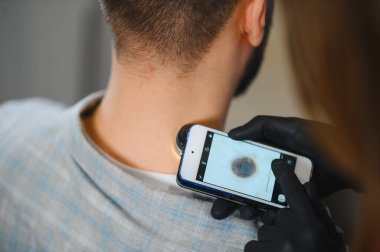 Siyah eldivenli doktor, boynundaki beni incelemek için akıllı telefonlu bir dermatoskop kullanıyor.
