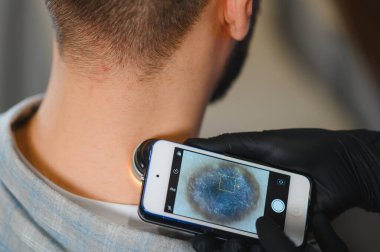 Dermatolog, cilt kanseri taraması için akıllı telefona bağlı bir dermatoskopla hastanın boynundaki beni inceliyor.