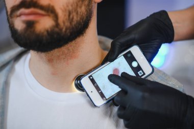 Cildiyeciler, cilt kanseri taraması için akıllı telefonlu bir dermatoskopla hastanın boynundaki beni inceliyor.