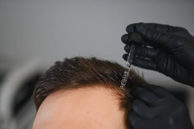 Trichologist, erkek hastanın kafa derisine pipetle serum uyguluyor, saç dökülmesini tedavi ediyor ve saç uzamasını destekliyor.