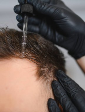 Saç dökülmesi için kafa derisi tedavisi sağlayan profesyonel bir trikoloğum. Erkek hastanın kafasına serum uygulamak için bir damlatıcı kullanıyor.