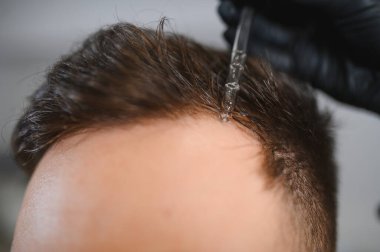 Bir adam pipet kullanarak doğrudan kafa derisine gençleştirme serumu uyguluyor. İnce saçları hedef alıyor ve folikül büyümesini teşvik ediyor.