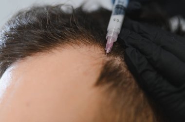 Elindeki siyah eldivenle hastanın kafa derisine mezoterapi uyguluyor. Saç restorasyonu ve alopecia tedavisi için büyüme konsepti