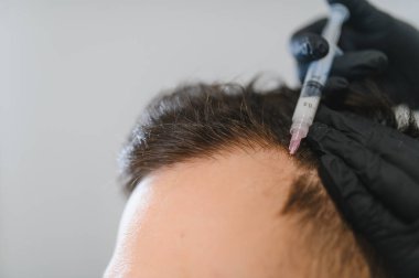 Hastamız saç dökülmesini önlemek ve büyümek için kafa derisi iğnesi yaptırıyor. Tıbbi uzman mezoterapi prosedürü uyguluyor.