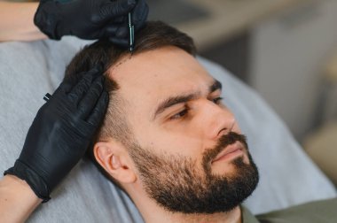 Saç yenileme prosedürü için kafa derisinde saç dökülmesi ve kelliğe dikkat çeken bir adam var.