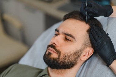 Profesyonel bir klinikte saç nakli prosedürü için saç muayenesi ve saç çizgisi olan erkek hasta.