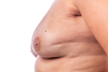 ECTOBER 2020 - FARO, PORTUGAL: Kanser tedavisinin yol açtığı yaralarla bir kadının göğsüne yakından bakmak.