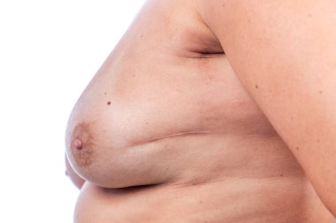 ECTOBER 2020 - FARO, PORTUGAL: Kanser tedavisinin yol açtığı yaralarla bir kadının göğsüne yakından bakmak.