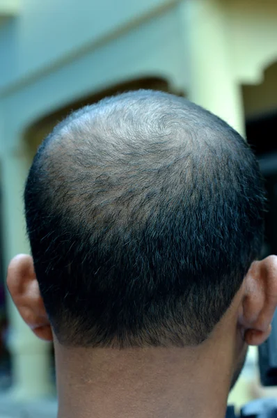 Skallig hår på huvudet — Stockfoto