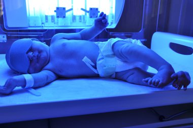 Newborn jaundice clipart