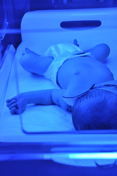 Newborn jaundice — Stock Photo, Image