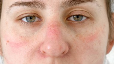 Tıbbi maske ve koruyucu gözlükleri çıkardıktan sonra doktorun yüzündeki bitkin gözler ve morluklar. Coronaviru ve covid-19 salgınına karşı savaşan sağlık çalışanları