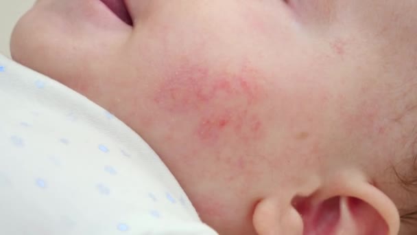 Primer plano de la cara del bebé con la piel roja que sufre de acné y dermatitis. Concepto de higiene del bebé recién nacido, salud y cuidado de la piel — Vídeos de Stock