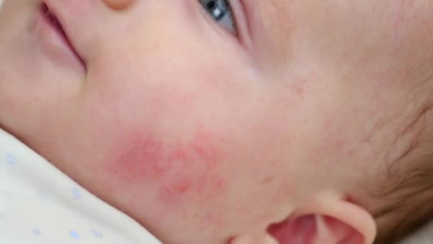 Крупный план кожи лица младенца с прыщами и прыщами от дерматита. Концепция гигиены новорожденных, здоровья и ухода за кожей — стоковое видео