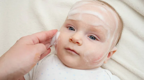 Применение лечебный лосьон или мазь на щеках младенцев, страдающих от дерматита и акне. Концепция гигиены новорожденных, здоровья и ухода за кожей — стоковое фото