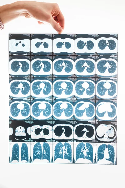 Fechar os resultados da tomografia dos pulmões na mão masculina — Fotografia de Stock