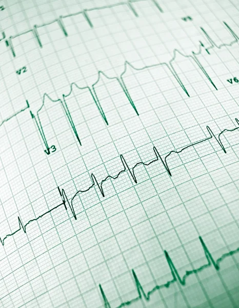 Electrocardiogram close up — Stock Photo, Image