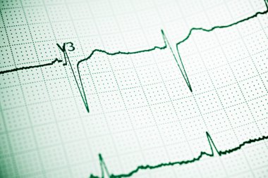 Elektrokardiyogramı kağıt formunda kapat.