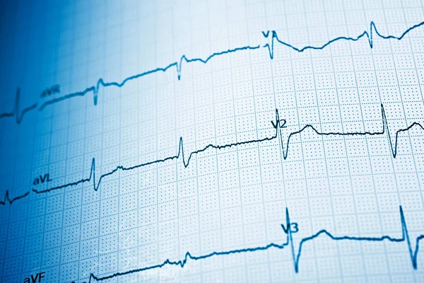 Primer Plano Electrocardiograma Forma Papel —  Fotos de Stock