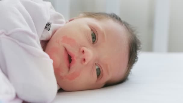 Rash and irritation around mouth of small child, skin problems Newborn girl with irritated skin on his face lying in bed and looking at world around him. Concept of problem skin disease, dermatologist — Stock Video