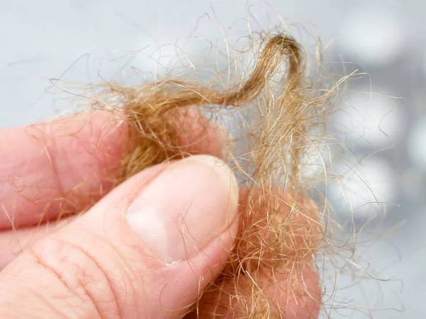 Problema Perdita Dei Capelli Bottiglie Con Medicina Spazzola Capelli Ciambella — Foto Stock