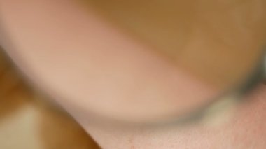 Doktor dermatolog hastanın doğum lekesini inceliyor. İyi huylu benler kontrol ediliyor