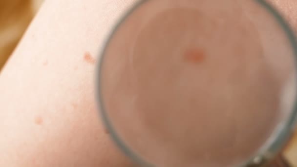 Dokter Dermatologis Memeriksa Tanda Lahir Pasien Memeriksa Tahi Lalat Jinak — Stok Video