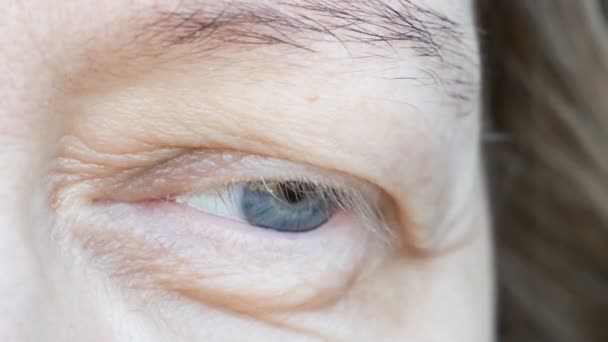 Middle Aged Female Eye Drooping Eyelid Ptosis Drooping Upper Eyelid — Stock Video