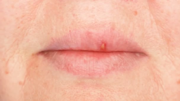 Herpes Herpes Labial Oral Ampollas Los Labios Mujer Herpes Simple — Vídeos de Stock