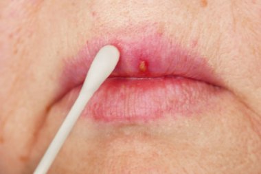 Herpes oral uçuk, kadın dudaklarında uçuk, yakın plan.