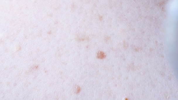 Dermatologe Untersucht Muttermal Des Patienten Überprüfung Gutartiger Maulwürfe — Stockvideo