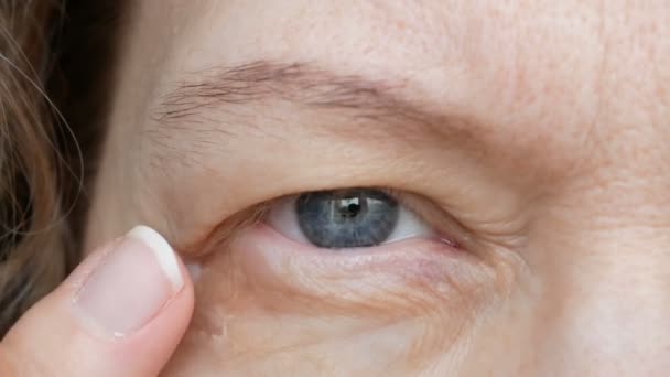 一名中年妇女正在做矫正眼部化妆品以矫正下垂的眼睑的特写镜头 乳腺炎是上眼睑或懒眼的下垂 美容学和面部概念 — 图库视频影像