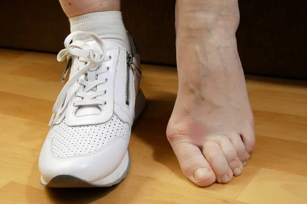 女人脱下她的白色运动鞋 挠了挠腿 脚趾间发红 有丝虫病 足部真菌病治疗概念 特写镜头 — 图库照片