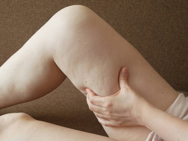 Целлюлитная женщина ущипнула ногу. Женские ноги с проблемой избыточного веса и целлюлита. Понятие липосакции. Крупный план