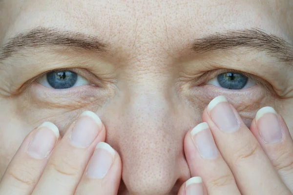 Mata Perempuan Paruh Baya Dengan Kelopak Mata Terkulai Ptosis Adalah — Stok Foto