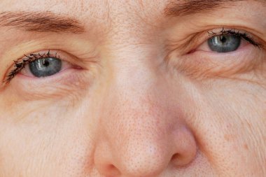 Kirpiklerinde rimel, göz iltihabı ve rimel alerjisi olan orta yaşlı bir kadın.
