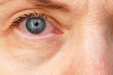 Kirpiklerinde rimel, göz iltihabı ve rimel alerjisi olan orta yaşlı bir kadın.