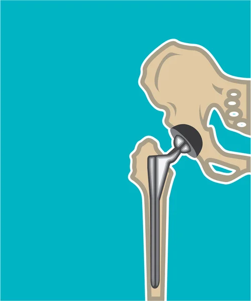 Hip Joint Replacement — Stock Vector