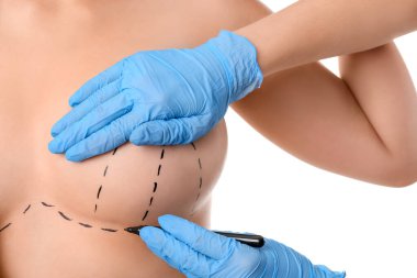 Doktor, beyaz arka plana estetik ameliyat yapılmadan önce kadın göğsüne izler çiziyor.