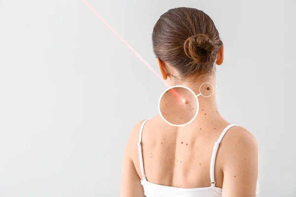 Young Woman Undergoing Procedure Nevus Removal Laser Light Background — Stock Photo, Image