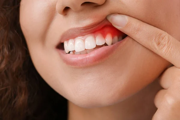 Wanita Dengan Peradangan Permen Karet Closeup — Stok Foto