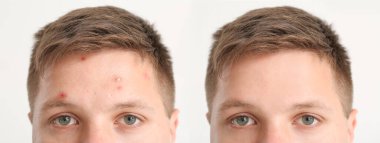 Beyaz arka planda sivilce tedavisinden önce ve sonra