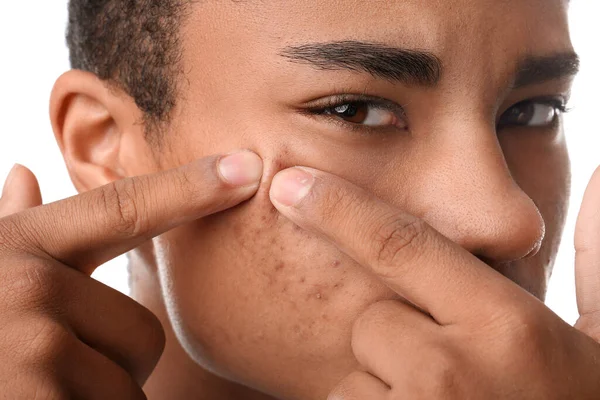 stock image African-American teenage boy with acne problem on white background, closeup