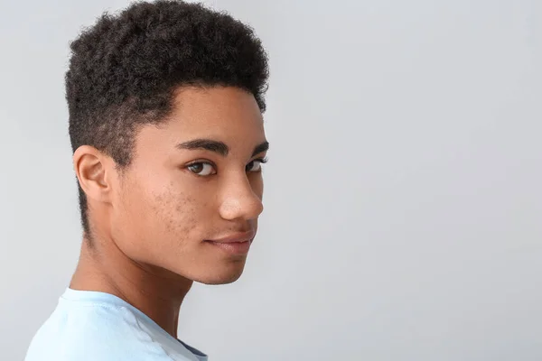 Afroamerikansk Teenage Dreng Med Acne Problem Lys Baggrund - Stock-foto