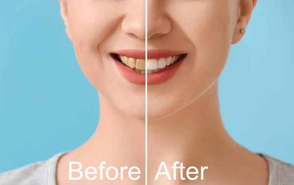 Mooie Jonge Vrouw Voor Glimlach Makeover Procedure Kleur Achtergrond Closeup — Stockfoto