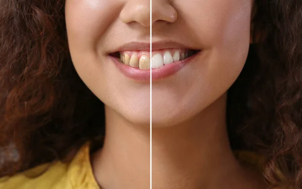 Hermosa Mujer Joven Antes Después Procedimiento Cambio Imagen Sonrisa Primer —  Fotos de Stock